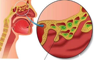 Research reveals a new mechanism for causing chronic sinusitis