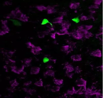 Studies have found that new lung cells can improve the treatment of cystic fibrosis