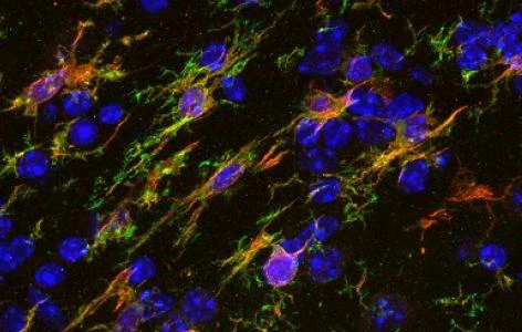 The study found key factors that promote the development of neurodegenerative diseases such as Alzheimer's disease