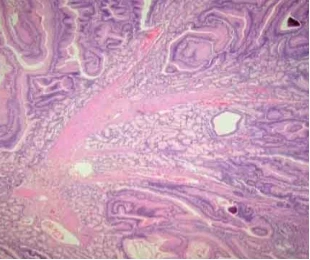 The study found that patients with melasma polyps syndrome may have stomach cancer