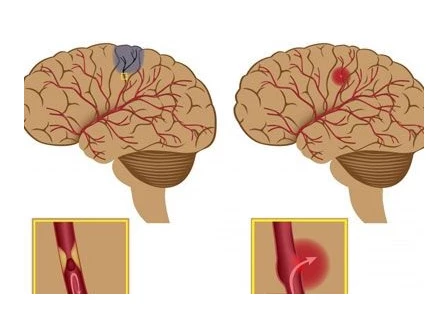 Umbilical cord blood helps relieve brain damage and restore cognitive and motor skills